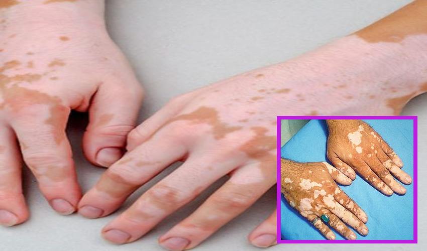 Vitiligo