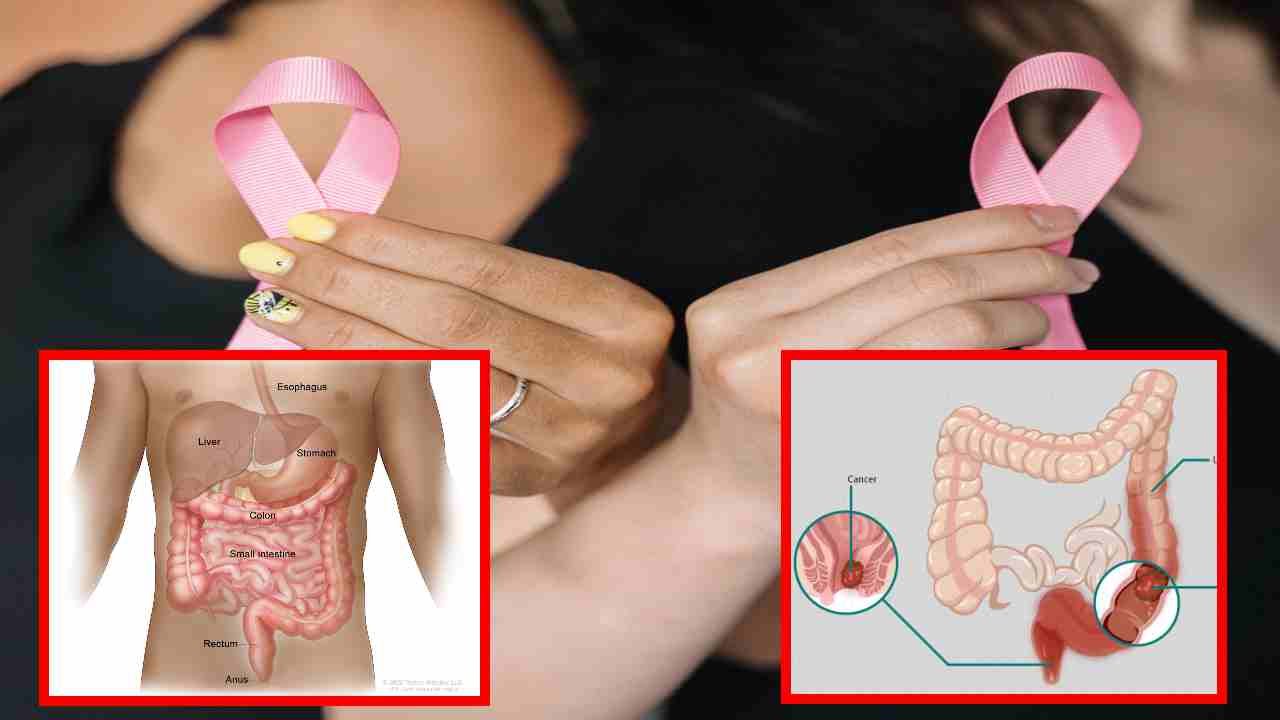 Colon Cancer : మలద్వారం నుండి రక్తం! పెద్ద పేగు క్యాన్సర్ కావొచ్చేమో? Colon Cancer : మలద్వారం నుండి రక్తం! పెద్ద పేగు క్యాన్సర్ కావొచ్చేమో?