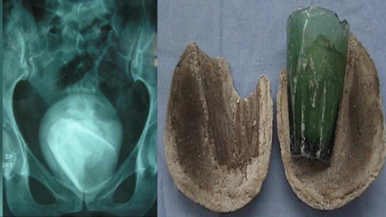 Glass Tumbler సీక్రెట్ ప్లేస్‌లో వాటర్ గ్లాస్ చొప్పించుకున్న మహిళ