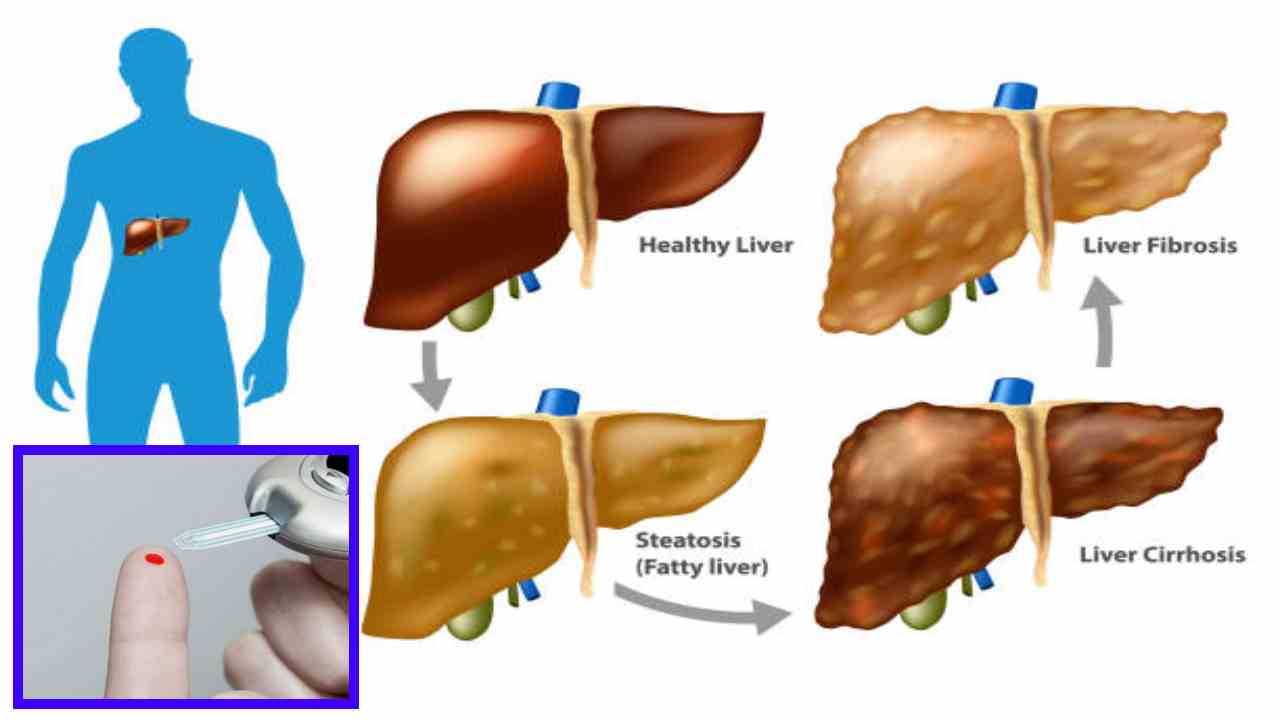 Diabetes : డయాబెటిస్ నుండి కాలేయాన్ని రక్షించుకోవటం ఎలా? Diabetes : డయాబెటిస్ నుండి కాలేయాన్ని రక్షించుకోవటం ఎలా?