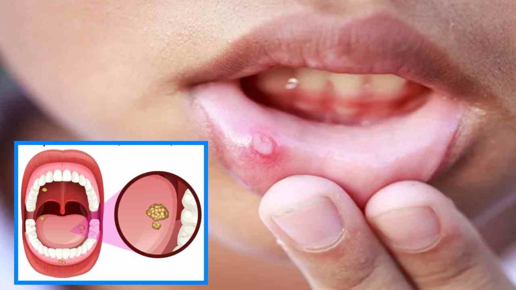 Mouth Ulcer (1)