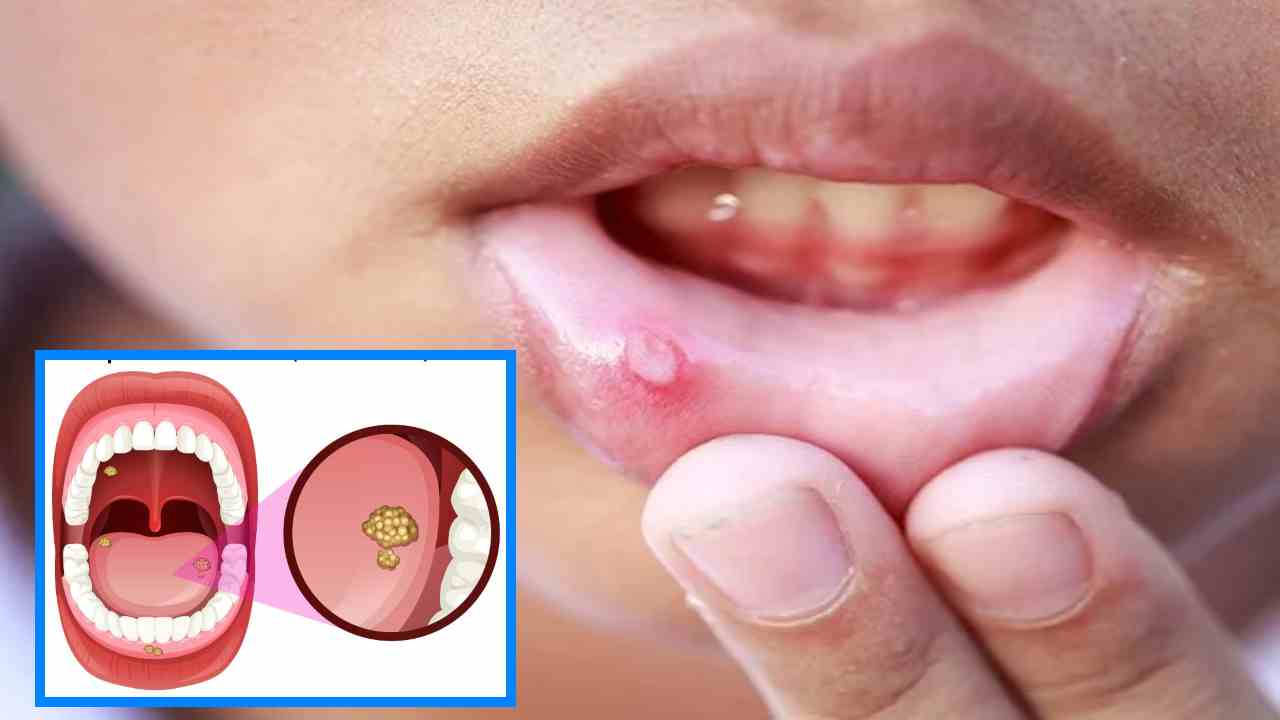 Mouth Ulcer : నోటిపూత సమస్యలు బాధిస్తుంటే! Mouth Ulcer : నోటిపూత సమస్యలు బాధిస్తుంటే!