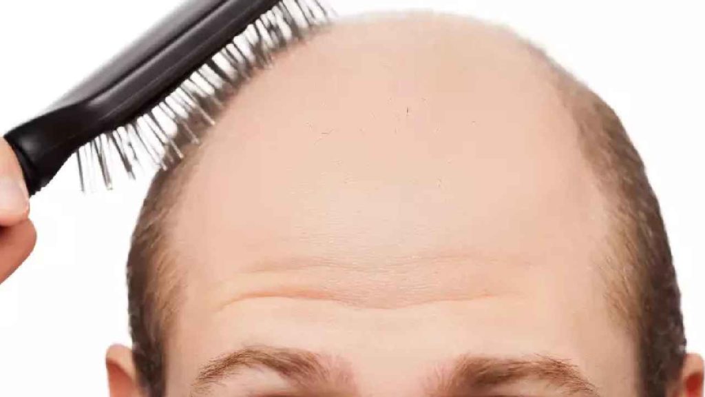 Bald Head (2)