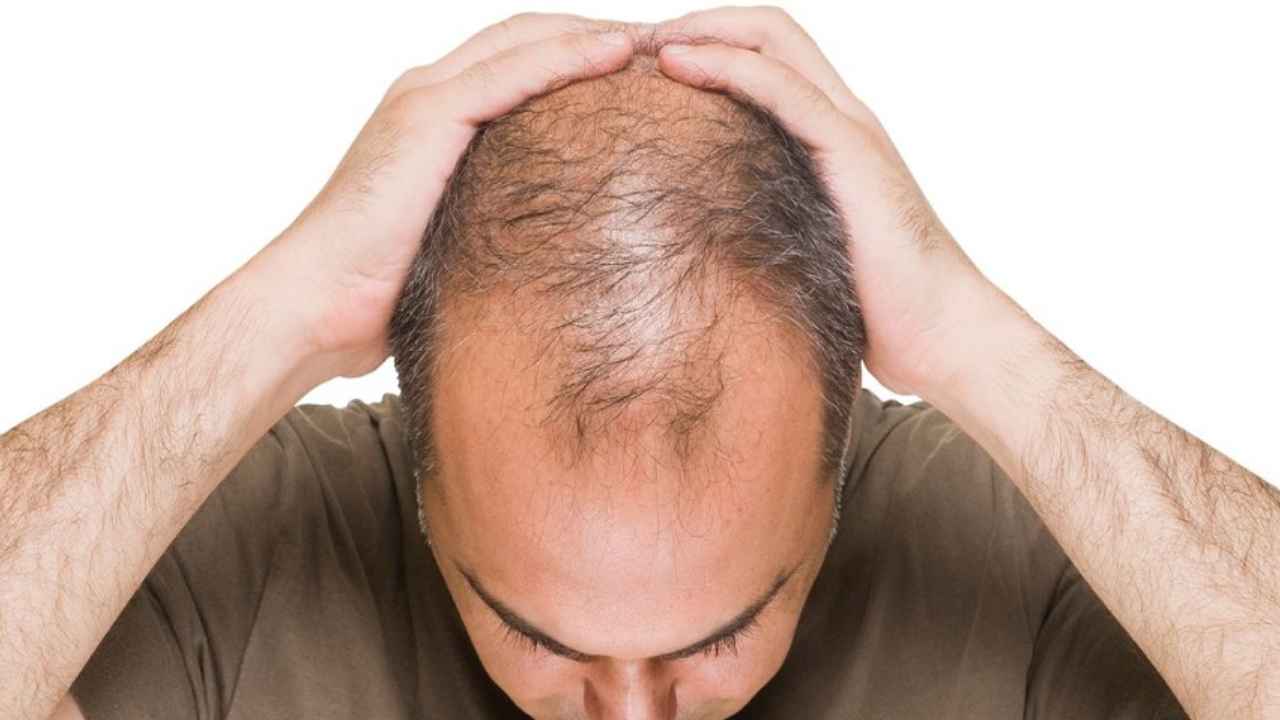 Bald Head: బట్టతలోడా.. అంటూ కామెంట్ చేస్తున్నారా? జాగ్రత్త.. జైలుకెళ్లాల్సి వస్తుంది.. Bald Head: బట్టతలోడా.. అంటూ కామెంట్ చేస్తున్నారా? జాగ్రత్త.. జైలుకెళ్లాల్సి వస్తుంది..