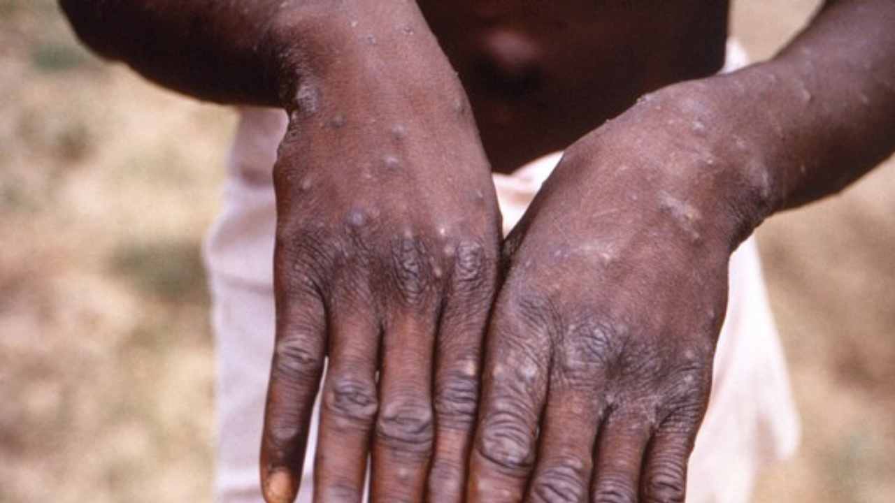 Belgium Becomes First Country To Introduce Monkeypox Quarantine, What We Know About The Virus So Far (1)