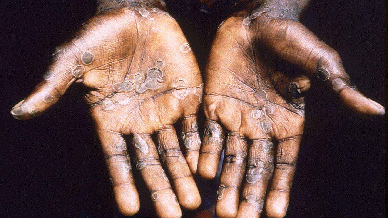 Monkeypox Quarantine : బెల్జియంలో మంకీపాక్స్ బాధితులకు క్వారంటైన్ మస్ట్.. ఇదే ఫస్ట్ కంట్రీ..! Monkeypox Quarantine : బెల్జియంలో మంకీపాక్స్ బాధితులకు క్వారంటైన్ మస్ట్.. ఇదే ఫస్ట్ కంట్రీ..!
