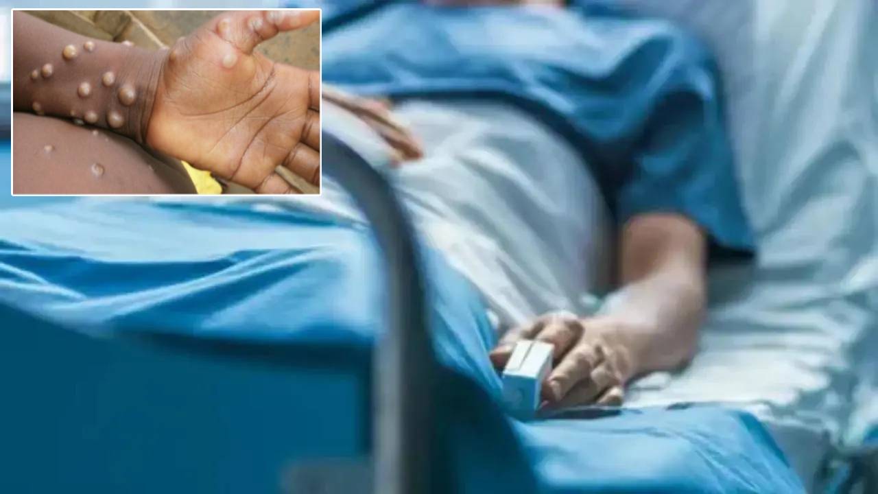 Monkeypox : ఇజ్రాయెల్లో మొదటి మంకీపాక్స్ కేసు.. ఈ లక్షణాలుంటే జాగ్రత్త..! Monkeypox : ఇజ్రాయెల్లో మొదటి మంకీపాక్స్ కేసు.. ఈ లక్షణాలుంటే జాగ్రత్త..!