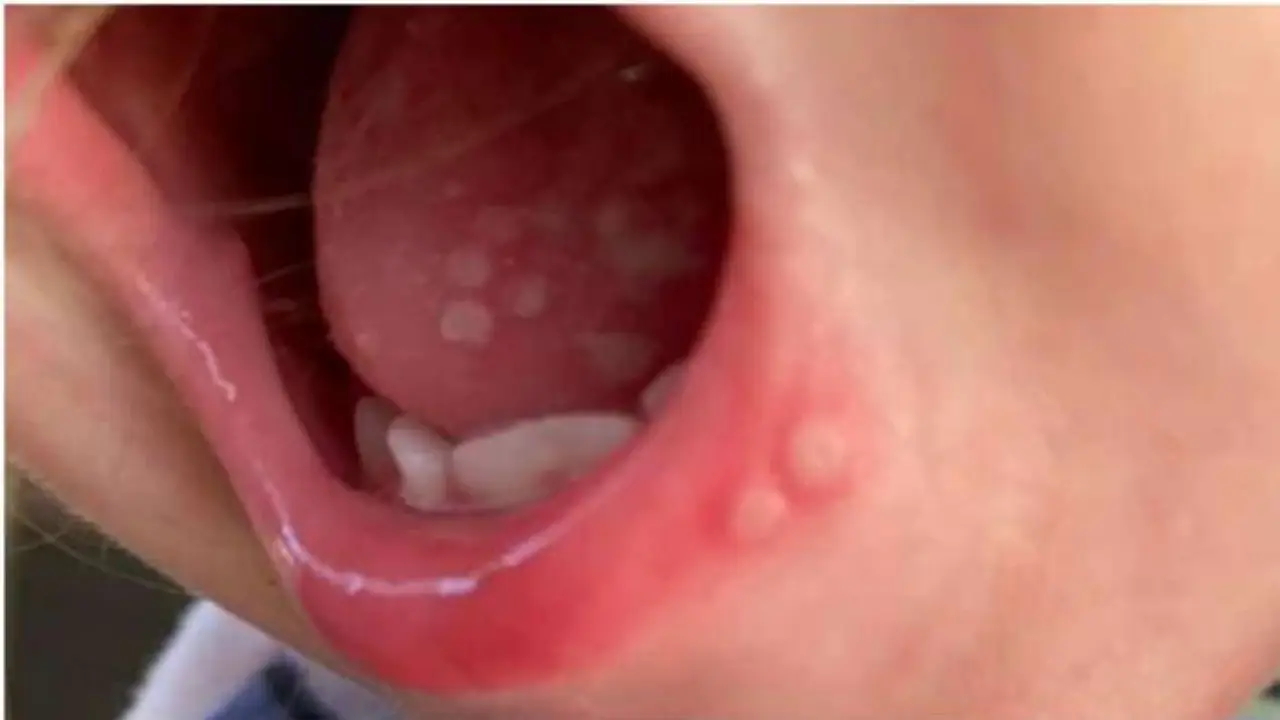 Tomato Flu Virus : కేరళలో టమాటా ఫ్లూ కలకలం..దాదాపు 10 కేసులు నమోదు Tomato Flu Virus : కేరళలో టమాటా ఫ్లూ కలకలం..దాదాపు 10 కేసులు నమోదు