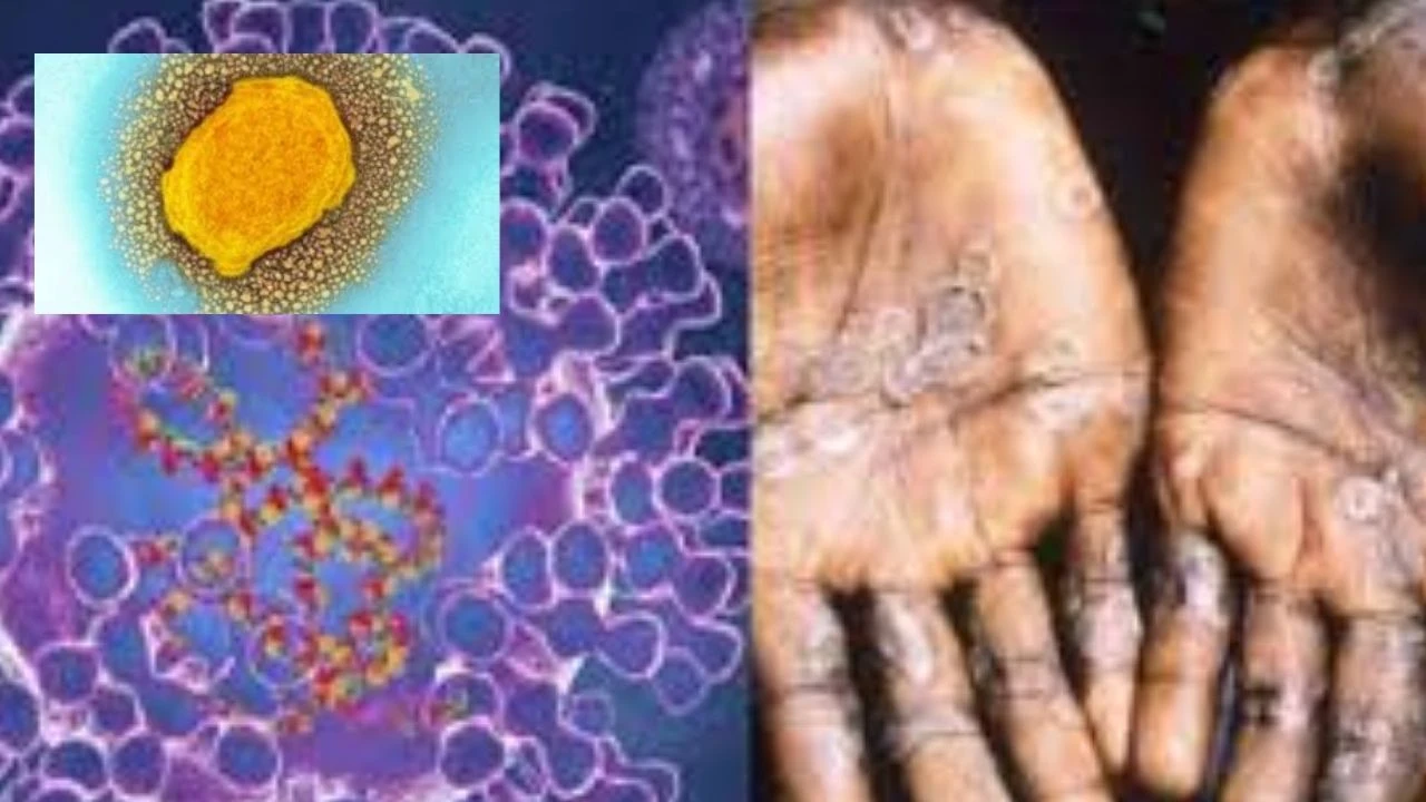 Monkeypox : స్వలింగ సంపర్కంతోనే మంకీపాక్స్!..వ్యాధి సోకిన వారితో దూరం పాటించాలి Monkeypox : స్వలింగ సంపర్కంతోనే మంకీపాక్స్!..వ్యాధి సోకిన వారితో దూరం పాటించాలి