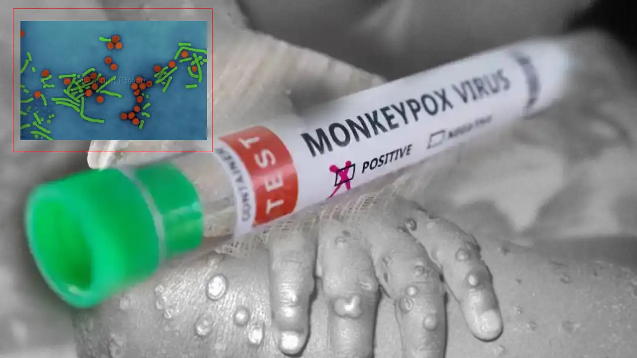 Monkeypox : ప్రపంచానికి మంకీపాక్స్ ముప్పు తప్పదా?కరోనాను మించిన పరిస్థితులు చూడబోతున్నామా? Monkeypox : ప్రపంచానికి మంకీపాక్స్ ముప్పు తప్పదా?కరోనాను మించిన పరిస్థితులు చూడబోతున్నామా?