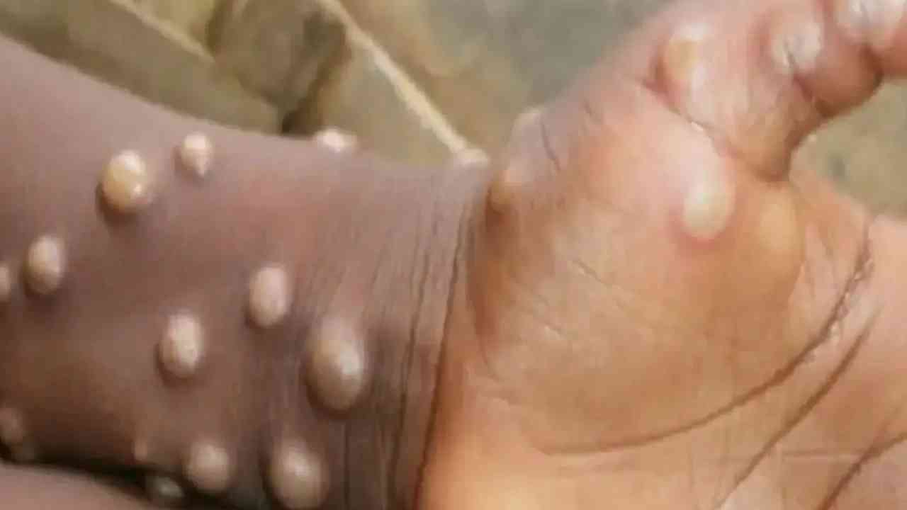 Monkeypox: మంకీపాక్స్పై అప్రమత్తమైన కేంద్రం.. రాష్ట్రాలకు సూచనలు Monkeypox: మంకీపాక్స్పై అప్రమత్తమైన కేంద్రం.. రాష్ట్రాలకు సూచనలు