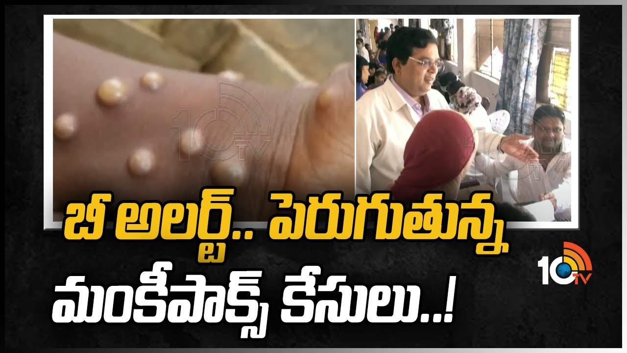 బీ అలర్ట్.. పెరుగుతున్న మంకీపాక్స్ కేసులు..!