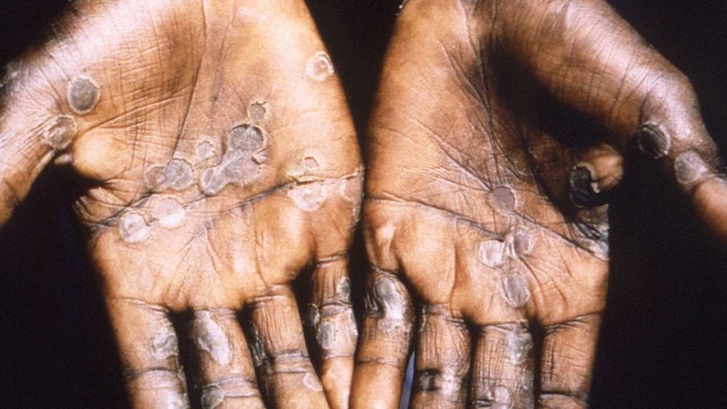 Monkeypox Spreads To 14 Countries; Compulsory Quarantine In Belgium (1)