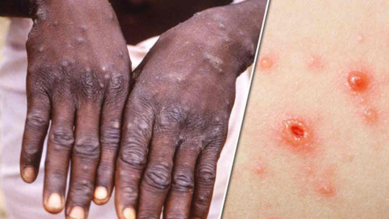 'no Need To Panic' Expert Says As Who Records 80 Monkeypox Cases In 11 Countries (1)