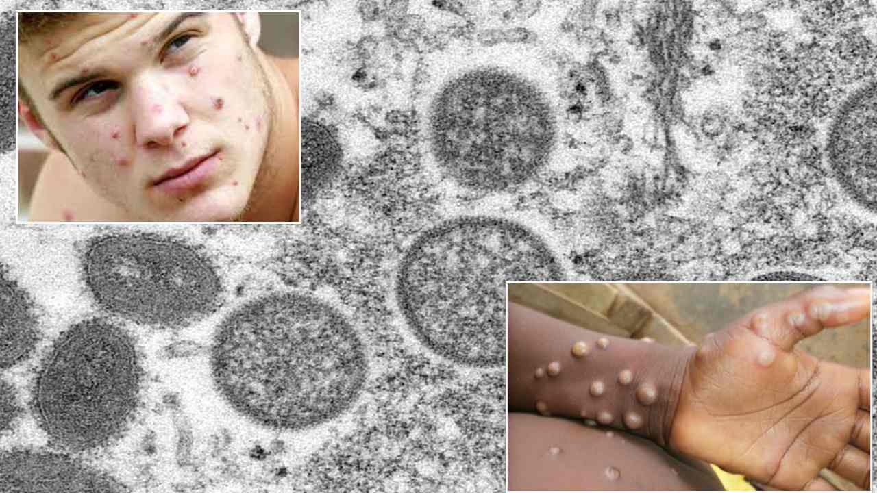 Monkeypox cases : 11 దేశాల్లో 80 మంకీపాక్స్ కేసులు.. అయినా ఆందోళనక్కర్లేదు.. నిపుణుల సూచన! Monkeypox cases : 11 దేశాల్లో 80 మంకీపాక్స్ కేసులు.. అయినా ఆందోళనక్కర్లేదు.. నిపుణుల సూచన!
