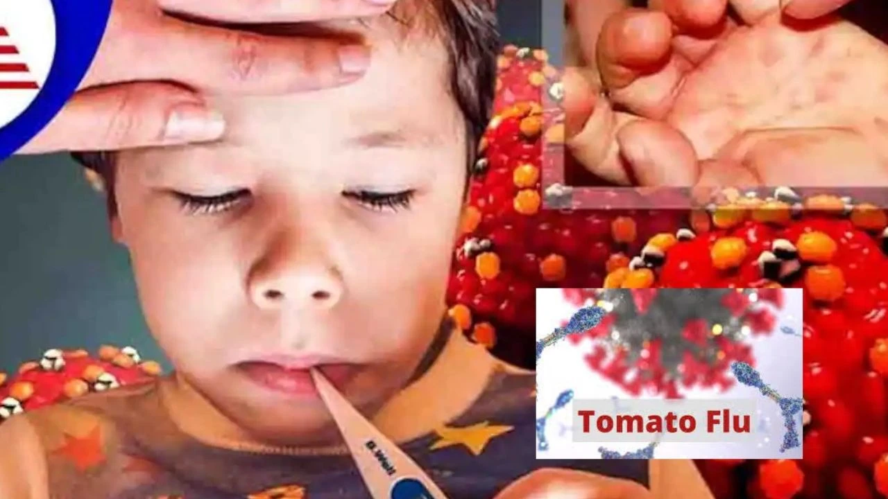 Tomato Fever: భారత్లో 82కి చేరిన టమాటా ఫ్లూ కేసులు.. ఒడిశాలో 26 మంది చిన్నారులకు వైరస్ Tomato Fever: భారత్లో 82కి చేరిన టమాటా ఫ్లూ కేసులు.. ఒడిశాలో 26 మంది చిన్నారులకు వైరస్