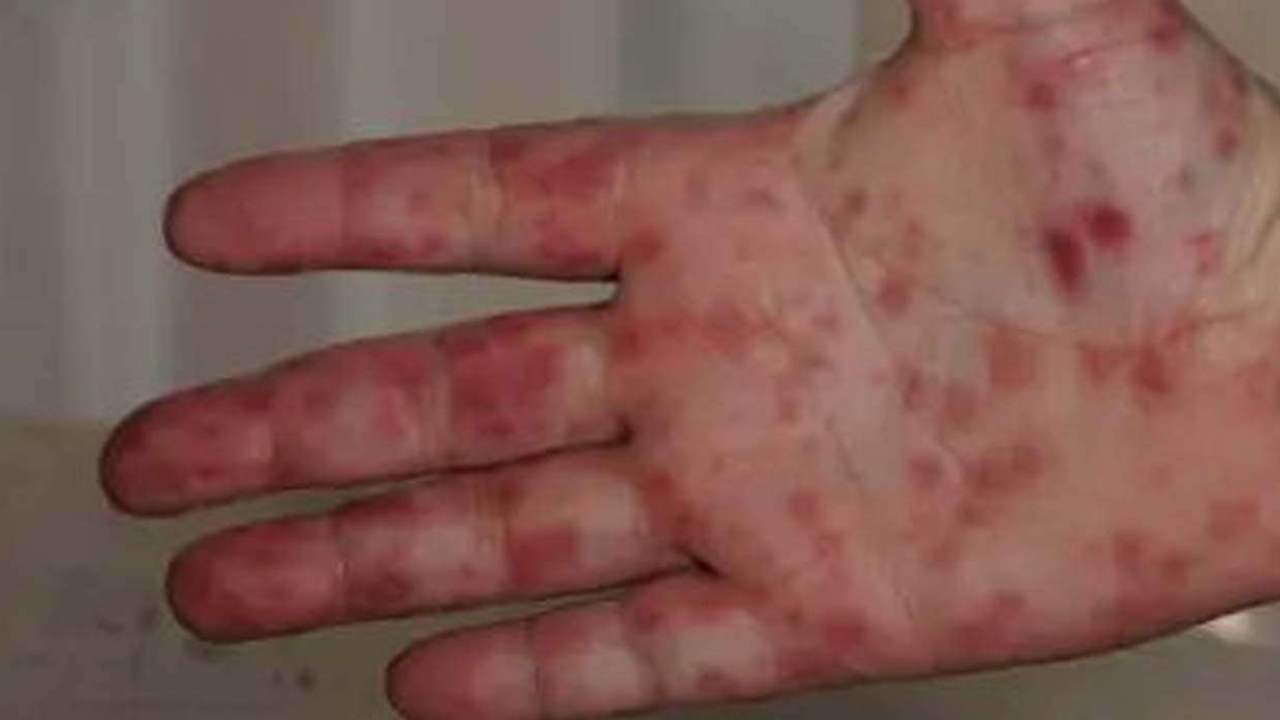 Tomato flu: భయపెడుతున్న టొమాటో ఫ్లూ.. దేశంలో పెరుగుతున్న కేసులు Tomato flu: భయపెడుతున్న టొమాటో ఫ్లూ.. దేశంలో పెరుగుతున్న కేసులు