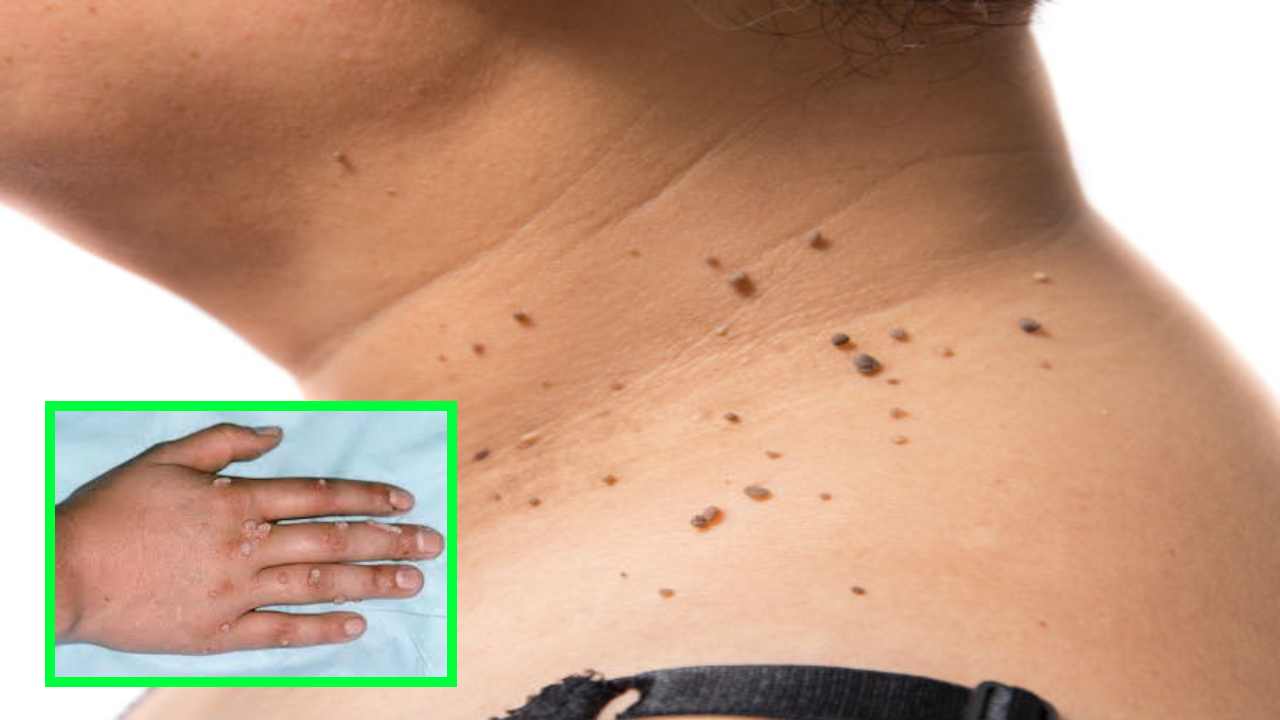WARTS : పులిపిర్లు ఎందుకొస్తాయ్! నివారణ ఎలాగంటే? WARTS : పులిపిర్లు ఎందుకొస్తాయ్! నివారణ ఎలాగంటే?