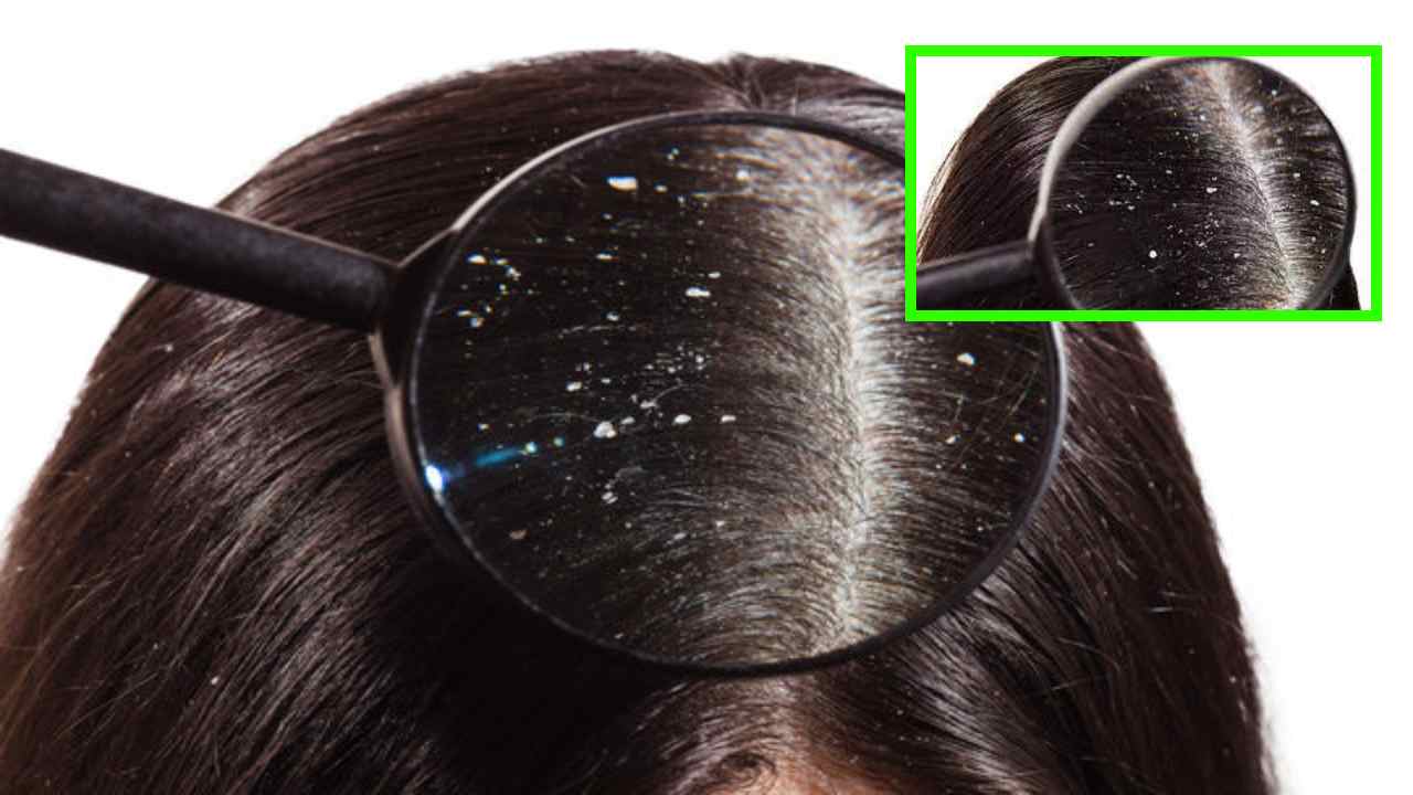 Dandruff Treatments: డాండ్రఫ్ నివారించేందుకు ఇంటి చిట్కాలు Dandruff Treatments: డాండ్రఫ్ నివారించేందుకు ఇంటి చిట్కాలు