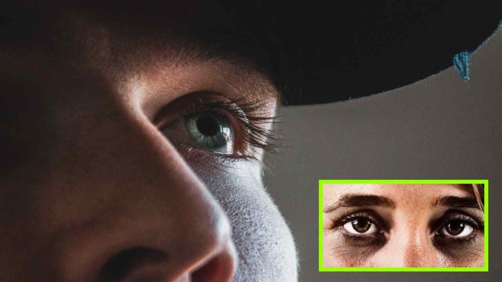 Dark Circles Under The Eye