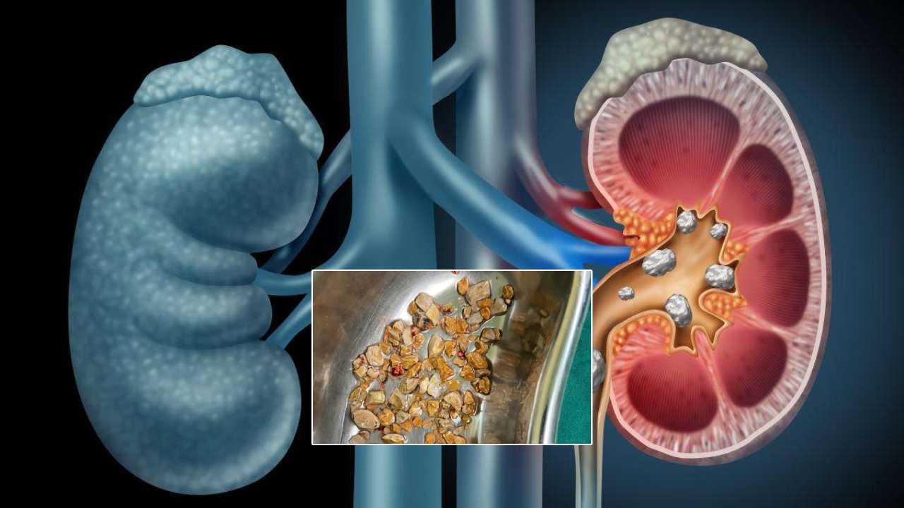 Kidney Stones: కిడ్నీలో 206రాళ్లను తొలగించిన డాక్టర్లు.. ఒక గంటలోనే Kidney Stones: కిడ్నీలో 206రాళ్లను తొలగించిన డాక్టర్లు.. ఒక గంటలోనే