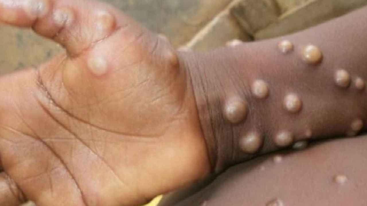 Monkeypox : మంకీపాక్స్ పై అలర్టైన తెలంగాణ-21 రోజులు ఐసోలేషన్ Monkeypox : మంకీపాక్స్ పై అలర్టైన తెలంగాణ-21 రోజులు ఐసోలేషన్