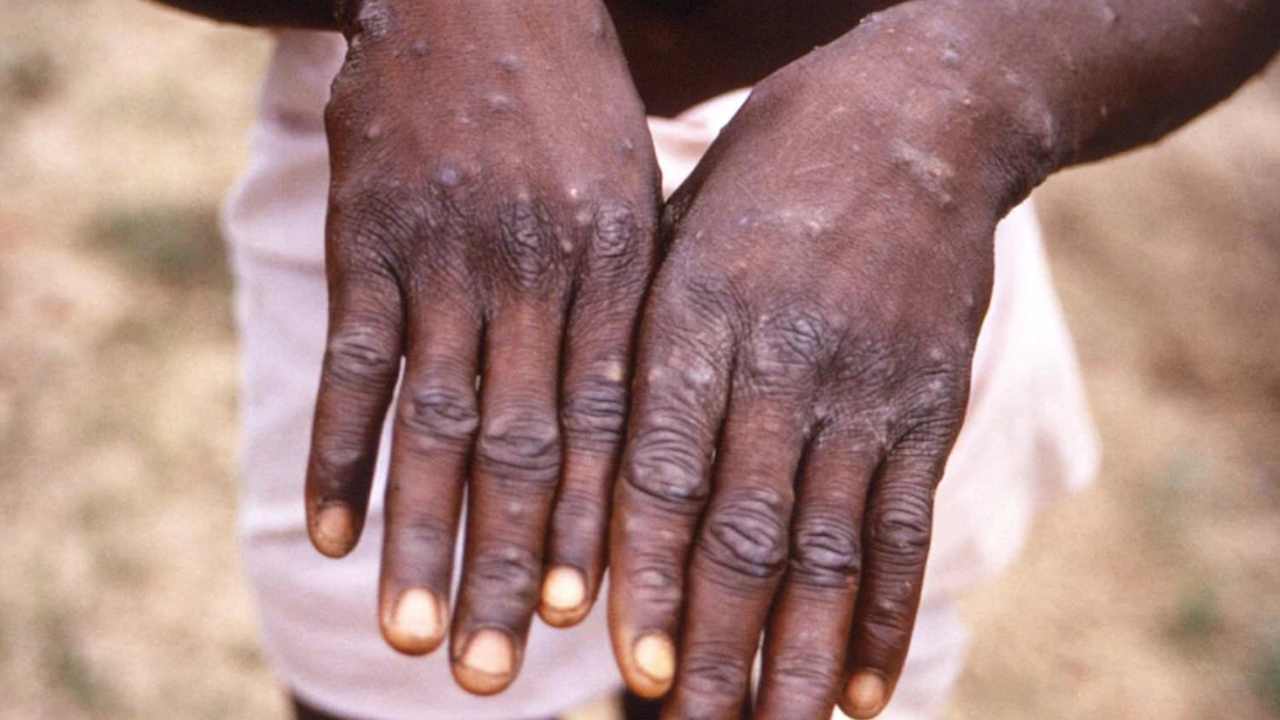 Monkeypox: మంకీపాక్స్ అంటే ఏమిటి? దానిని ఎలా గుర్తించాలి.. లక్షణాలేంటి..? Monkeypox: మంకీపాక్స్ అంటే ఏమిటి? దానిని ఎలా గుర్తించాలి.. లక్షణాలేంటి..?