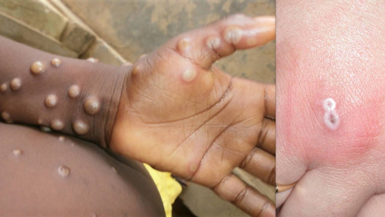 Monkeypox: ప్రపంచ వ్యాప్తంగా పెరుగుతున్న మంకీపాక్స్ కేసులు.. అప్రమత్తమైన కేంద్రం Monkeypox: ప్రపంచ వ్యాప్తంగా పెరుగుతున్న మంకీపాక్స్ కేసులు.. అప్రమత్తమైన కేంద్రం