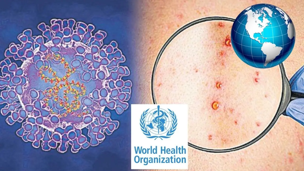 Monkeypox : మంకిపాక్స్ డేంజర్ బెల్స్..పది రోజుల్లోనే 12 దేశాలకు విస్తరించిన వైరస్ Monkeypox : మంకిపాక్స్ డేంజర్ బెల్స్..పది రోజుల్లోనే 12 దేశాలకు విస్తరించిన వైరస్