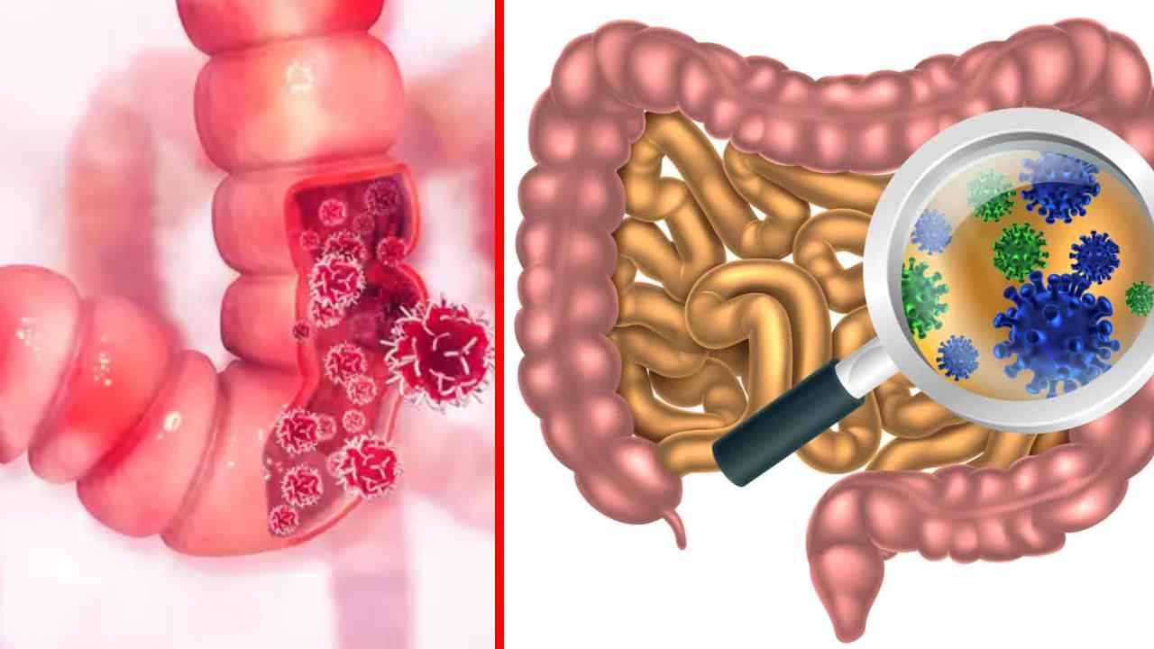 Colon Cancer : ఆలక్షణాలుంటే పెద్ద పేగు క్యాన్సర్ గా అనుమానించాల్సిందే! Colon Cancer : ఆలక్షణాలుంటే పెద్ద పేగు క్యాన్సర్ గా అనుమానించాల్సిందే!