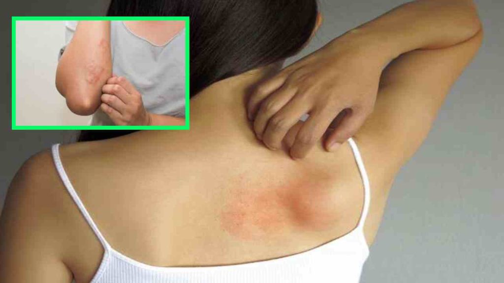 Fungal Infections
