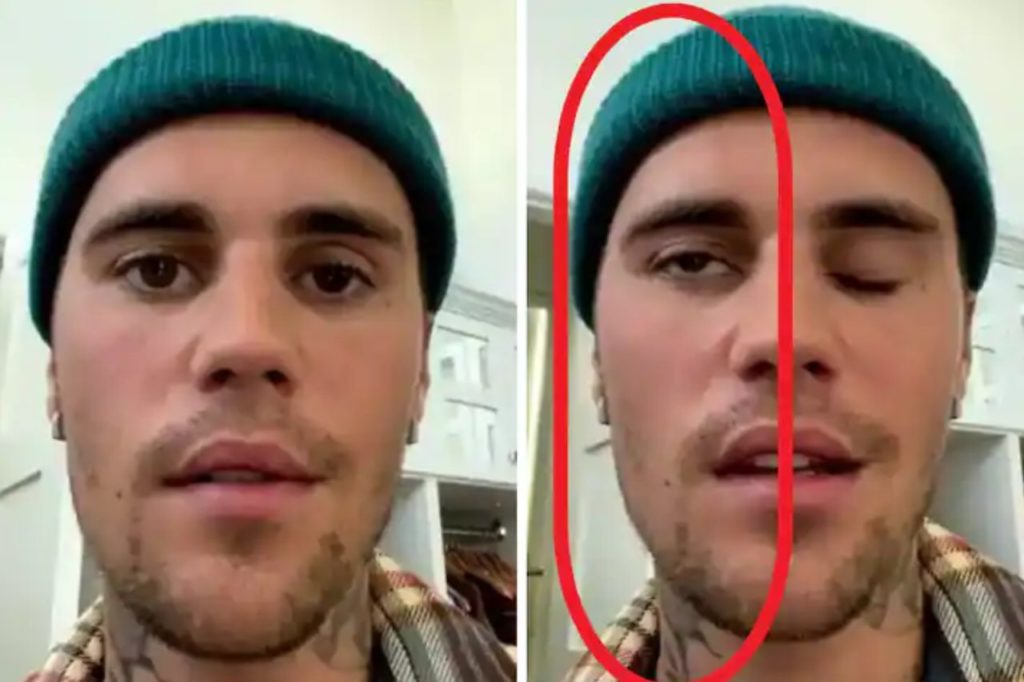 Justin Bieber Suffers Facial Paralysis