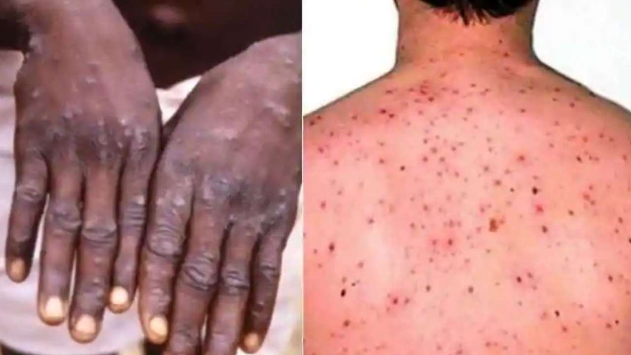 Monkeypox Virus: వణికిస్తున్న మంకీపాక్స్.. 27దేశాల్లో వైరస్ వ్యాప్తి .. భారత్లో.. Monkeypox Virus: వణికిస్తున్న మంకీపాక్స్.. 27దేశాల్లో వైరస్ వ్యాప్తి .. భారత్లో..