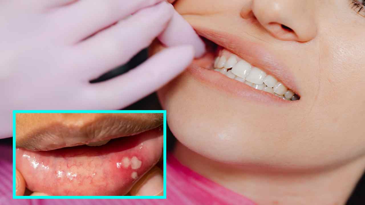 MOUTH ULCERS : నోటిపూత సమస్యా? ఉపశమనానికి చిట్కాలు MOUTH ULCERS : నోటిపూత సమస్యా? ఉపశమనానికి చిట్కాలు