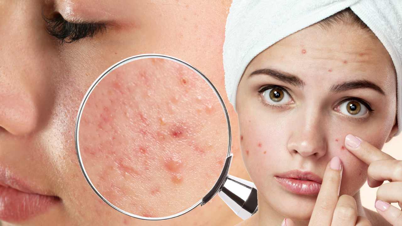 Pimples on Face: యుక్త వయస్సు దాటాక కూడా మొటిమలు వస్తున్నాయా.. Pimples on Face: యుక్త వయస్సు దాటాక కూడా మొటిమలు వస్తున్నాయా..