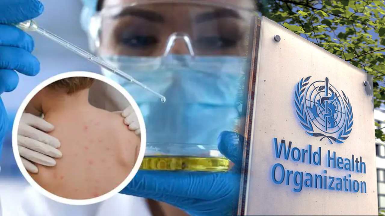 Monkeypox Virus: మంకీపాక్స్ వైరస్ పేరుమార్చిన డబ్ల్యూహెచ్ఓ Monkeypox Virus: మంకీపాక్స్ వైరస్ పేరుమార్చిన డబ్ల్యూహెచ్ఓ
