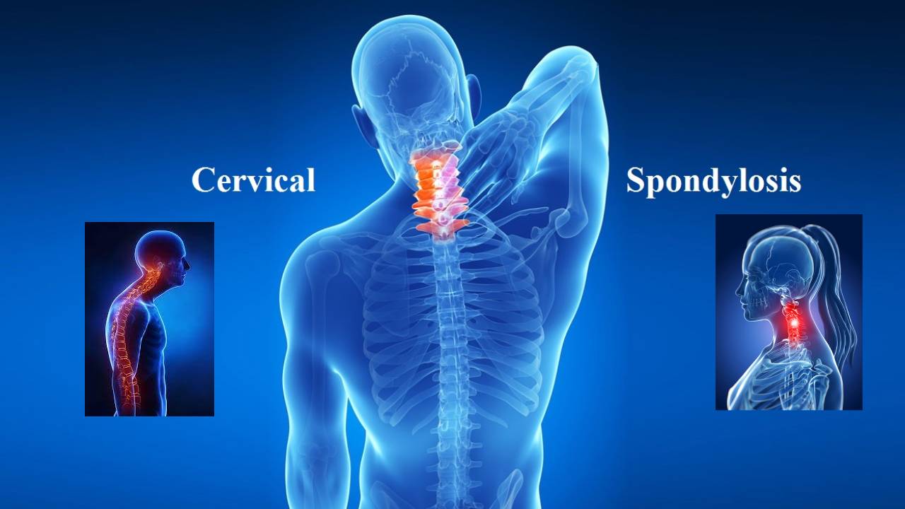 Cervical Spondylosis: సర్వికల్ స్పాండిలోసిస్ కోసం 5 యోగాసనాలు Cervical Spondylosis: సర్వికల్ స్పాండిలోసిస్ కోసం 5 యోగాసనాలు