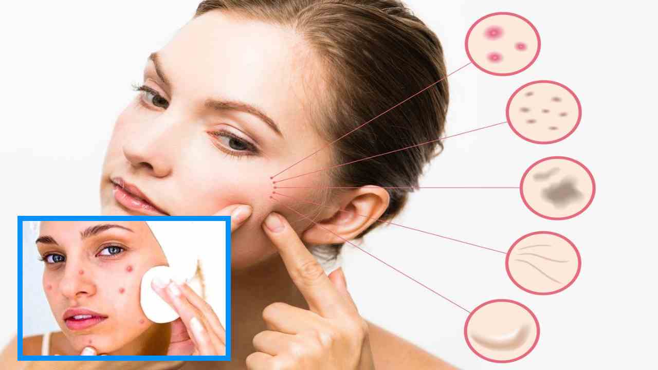 Acne Problem : యుక్త వయస్సులో మొటిమల సమస్య! Acne Problem : యుక్త వయస్సులో మొటిమల సమస్య!