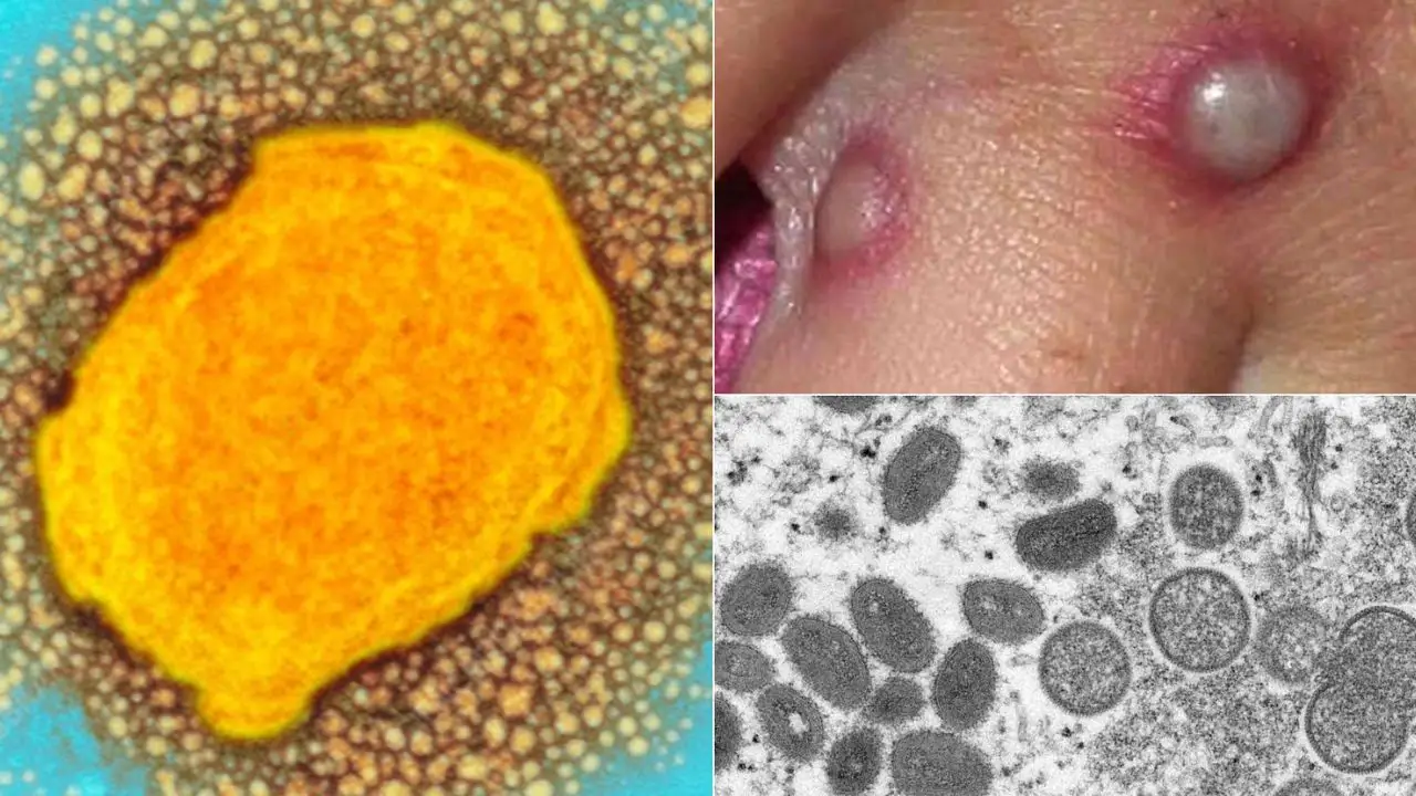 Monkeypox : రూపం మార్చుకున్న మంకీపాక్స్..బ్రిటన్లోని రోగుల్లో వేరే లక్షణాలు Monkeypox : రూపం మార్చుకున్న మంకీపాక్స్..బ్రిటన్లోని రోగుల్లో వేరే లక్షణాలు