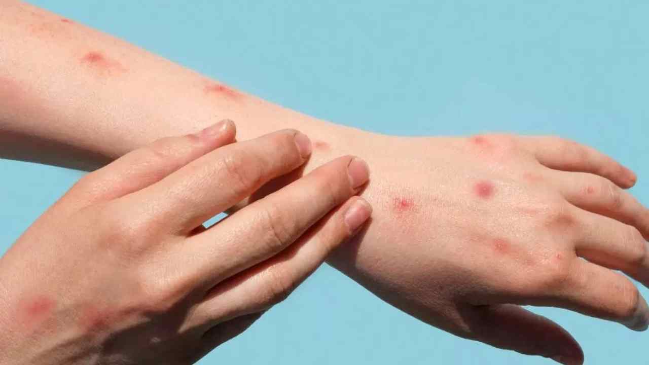 Monkeypox: కామారెడ్డి మంకీపాక్స్ కేసు.. హైదరాబాద్ ఫీవర్ ఆస్పత్రిలో చికిత్స Monkeypox: కామారెడ్డి మంకీపాక్స్ కేసు.. హైదరాబాద్ ఫీవర్ ఆస్పత్రిలో చికిత్స