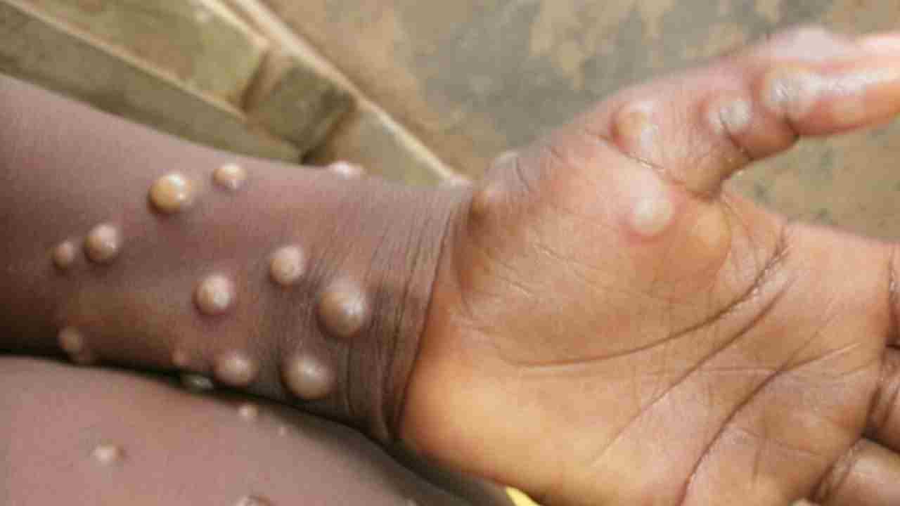 Monkeypox: ఖమ్మంలో మంకీపాక్స్ కలకలం.. లక్షణాలున్న వ్యక్తిని హైదరాబాద్ తరలింపు Monkeypox: ఖమ్మంలో మంకీపాక్స్ కలకలం.. లక్షణాలున్న వ్యక్తిని హైదరాబాద్ తరలింపు