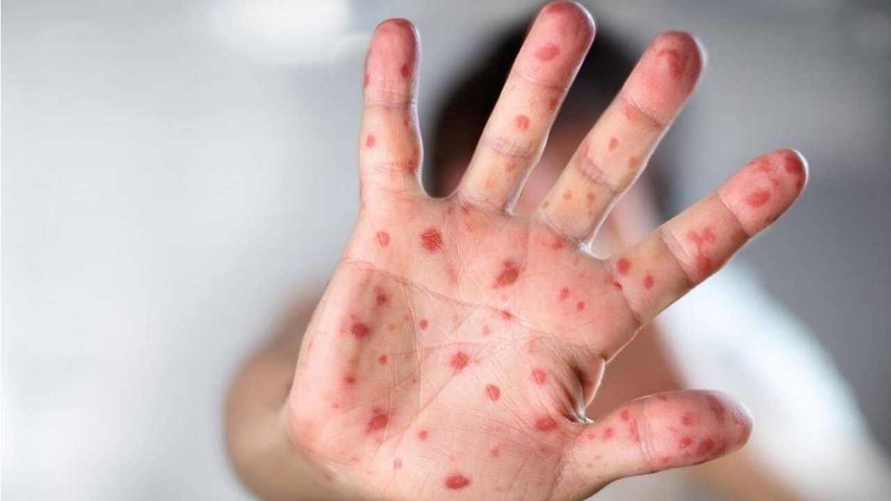 Monkeypox: చెలరేగిపోతున్న మంకీపాక్స్.. హెల్త్ ఎమర్జెన్సీగా ప్రకటించిన యూఎస్ Monkeypox: చెలరేగిపోతున్న మంకీపాక్స్.. హెల్త్ ఎమర్జెన్సీగా ప్రకటించిన యూఎస్