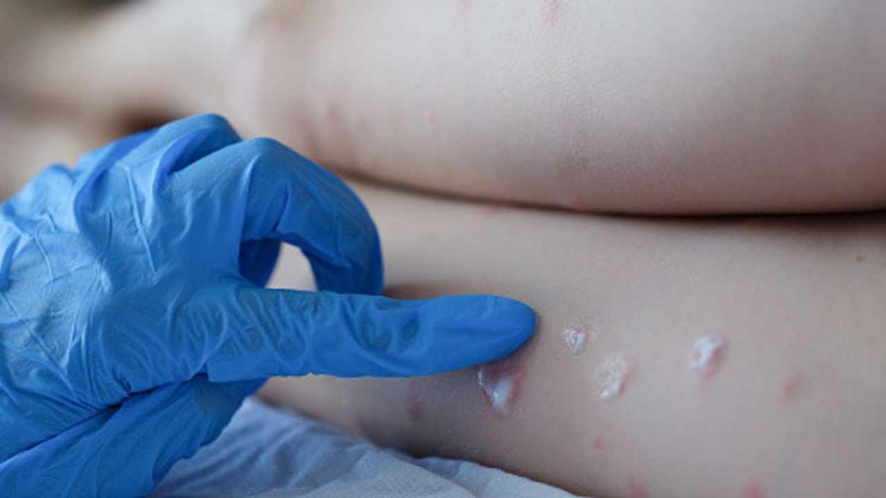 Monkeypox: స్పెయిన్లో మంకీపాక్స్ రోగి మృతి Monkeypox: స్పెయిన్లో మంకీపాక్స్ రోగి మృతి