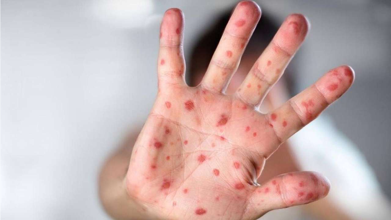 Monkeypox: పెరుగుతున్న మంకీపాక్స్ కేసులు.. గ్లోబల్ హెల్త్ ఎమర్జెన్సీగా ప్రకటించిన డబ్ల్యూహెచ్ఓ Monkeypox: పెరుగుతున్న మంకీపాక్స్ కేసులు.. గ్లోబల్ హెల్త్ ఎమర్జెన్సీగా ప్రకటించిన డబ్ల్యూహెచ్ఓ