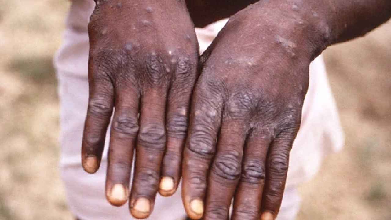 Vijayawada Monkeypox : విజయవాడ వాసులకు బిగ్ రిలీఫ్.. అది మంకీపాక్స్ కాదు Vijayawada Monkeypox : విజయవాడ వాసులకు బిగ్ రిలీఫ్.. అది మంకీపాక్స్ కాదు
