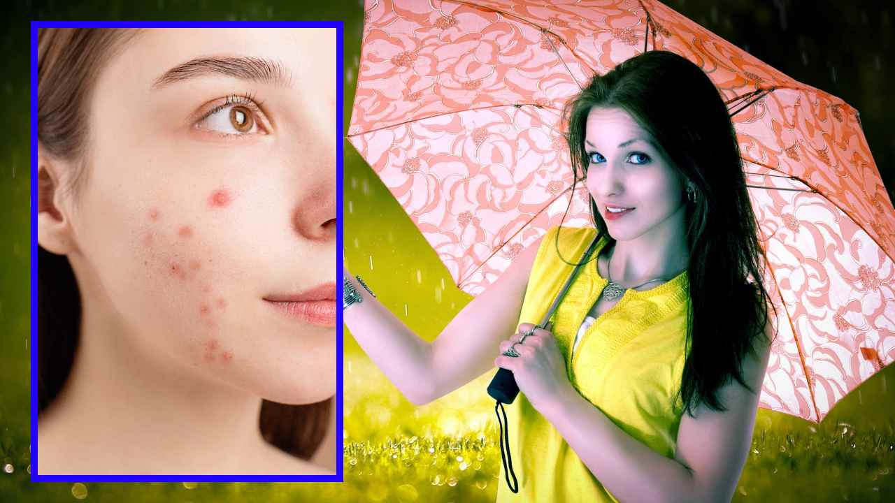 Acne Problem : వర్షాకాలంలో వేధించే మొటిమల సమస్య! Acne Problem : వర్షాకాలంలో వేధించే మొటిమల సమస్య!