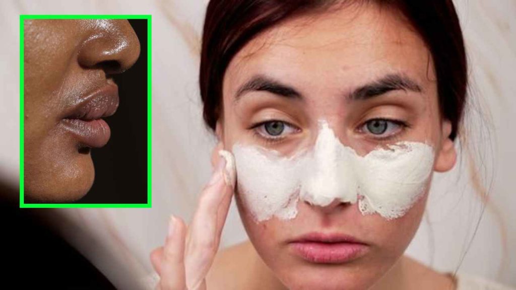 Blackheads