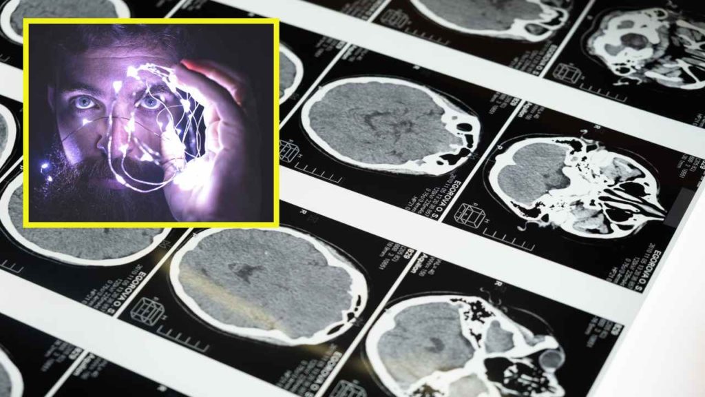 Brain Stroke