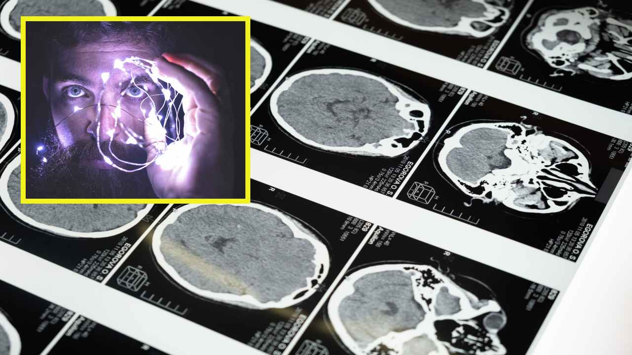 Brain Stroke : అధిక రక్తపోటు, కొలెస్ట్రాల్ తో బ్రెయిన్ స్ట్రోక్ ముప్పు! Brain Stroke : అధిక రక్తపోటు, కొలెస్ట్రాల్ తో బ్రెయిన్ స్ట్రోక్ ముప్పు!