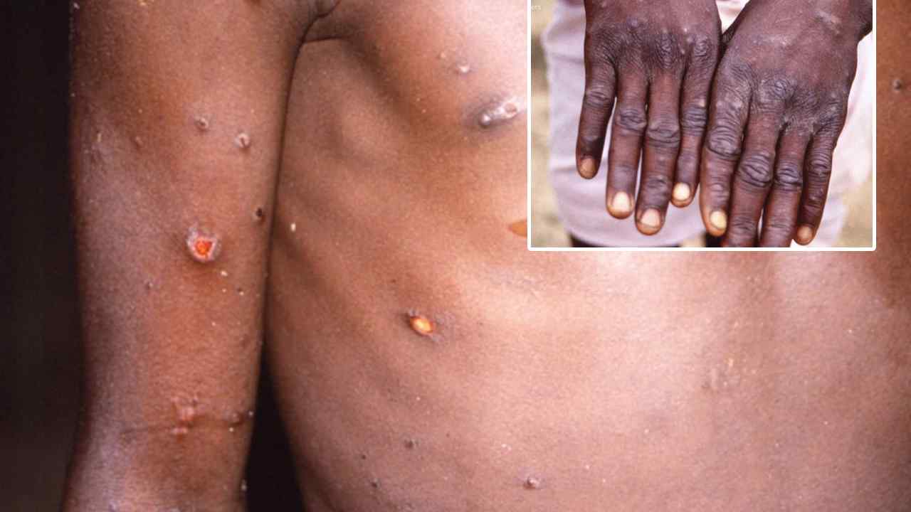 Monkeypox: భారత్లో తొలి మంకీపాక్స్ బాధితుడు పూర్తిగా కోలుకున్నాడు: కేరళ ఆరోగ్య శాఖ మంత్రి Monkeypox: భారత్లో తొలి మంకీపాక్స్ బాధితుడు పూర్తిగా కోలుకున్నాడు: కేరళ ఆరోగ్య శాఖ మంత్రి